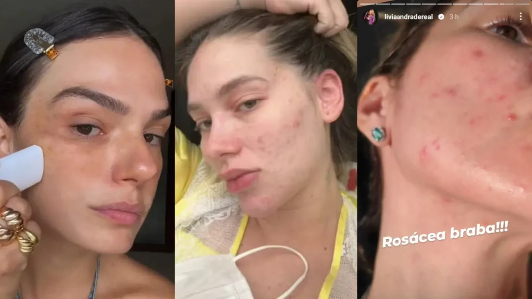 acaro-microscopico-pode-ser-o-causador-da-rosacea-de-famosas acaro-microscopico-pode-ser-o-causador-da-rosacea-de-famosas