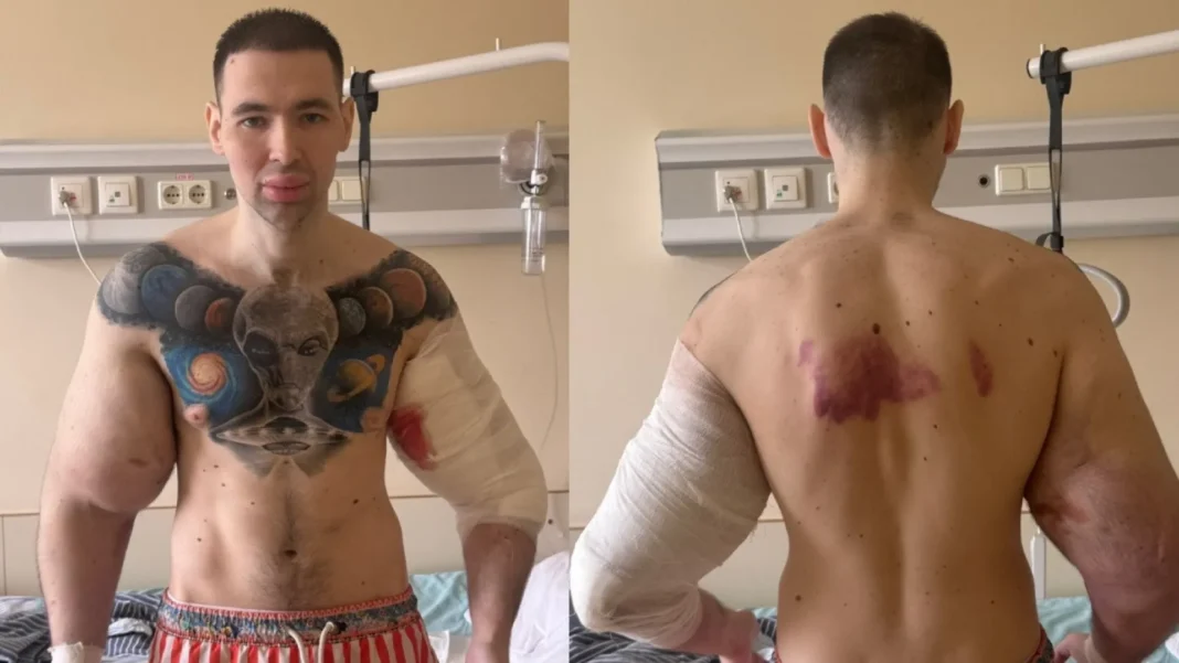 popeye-russo-remove-substancias-dos-bracos-apos-anos-de-exageros-esteticos